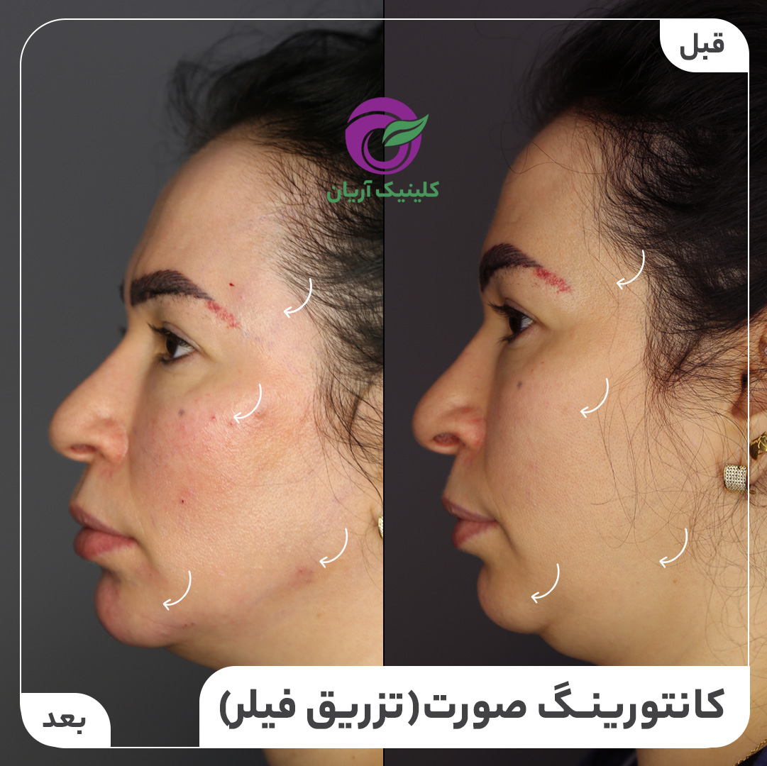 تصاویر قبل و بعد از تزریق ژل